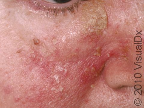 Severe red, scaly elevations of the skin can develop a thick, 