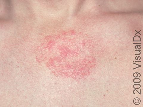 Seborrhiec dermatits can affect the upper chest and have round, red areas in addition to slight scaling.