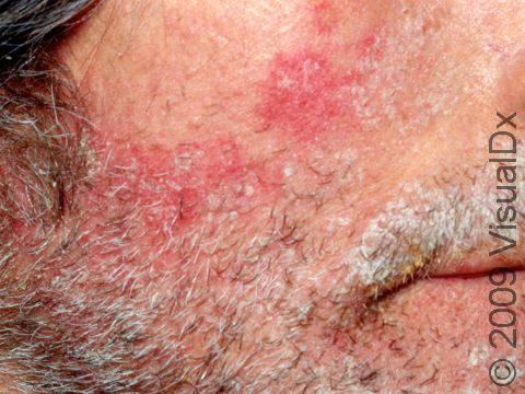 The beard area is a common location for seborrheic dermatitis as displayed in this image.