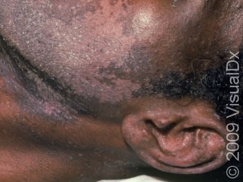This image displays a Black patient with temporary lightening of the skin due to widespread seborrheic dermatitis.