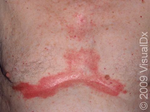 Seborrheic dermatitis often affects the chest in men with red, slightly scaling, round patches of both the breastbone and under the breasts.