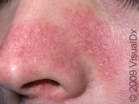This image displays the fine scaliness and redness of the nose and cheek typical of seborrheic dermatitis.