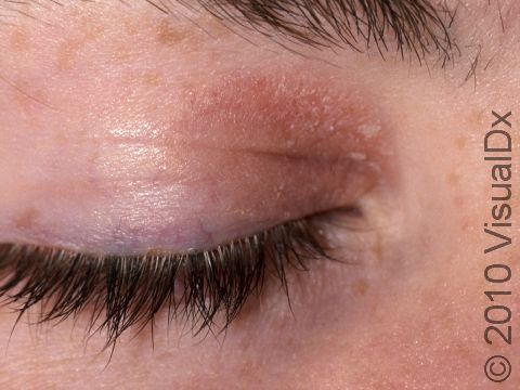 Seborrheic dermatitis often affects the eyelid or eyebrow regions.