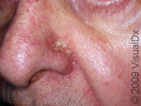 The fold between the nose and the cheek is a common location for seborrheic dermatitis.