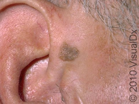 Seborrheic keratoses are common, benign skin lesions in adults. They have a 