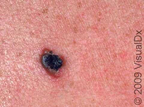 A seborrheic keratosis lesion can sometimes become black, as displayed in this image.