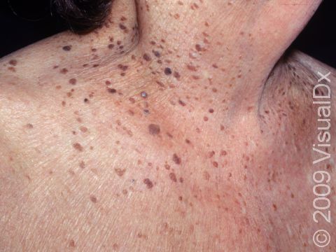 The dark to light brown raised, rough areas of seborrheic keratoses may be numerous in the elderly.