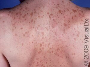This image displays many solar lentigines due to the person having many sunburns as a child and teenager.