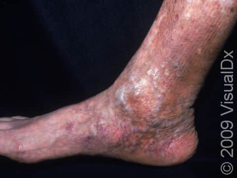 This image displays long-standing stasis dermatitis and varicose veins associated with swelling and inflammation in the skin.