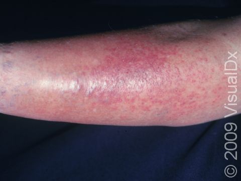 This image displays a lower leg with poor vein function (stasis) that has developed red, itchy dermatitis as well as swelling.