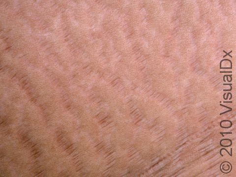 The thinned skin in striae has a wrinkled, crepe-paper-like appearance.