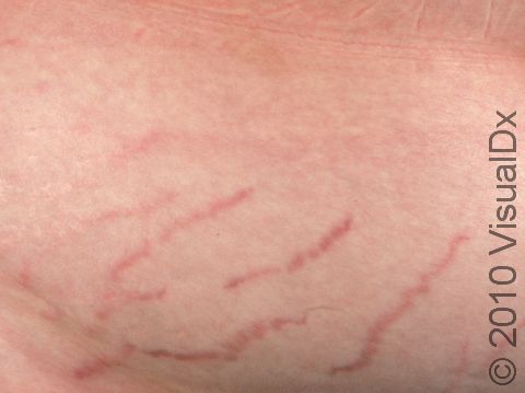 This image displays bright red striae (stretch marks) in parallel lines, as is typical in early instances.