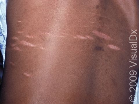 This image displays pink striae (stretch marks) on a back.