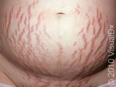 Dark purple, linear stretch marks (striae) are common on the belly of pregnant individuals.