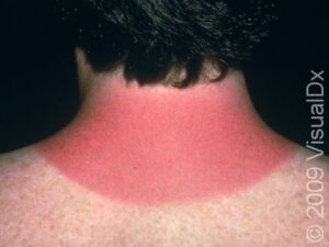 Sunburn Example Sunburn Condition, Treatments and Pictures for Adults - Skinsight
