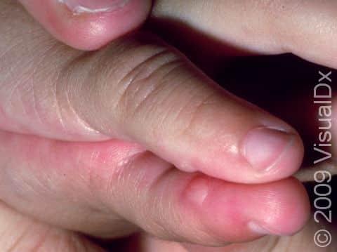In this baby, very small bumps on the sides of both fifth fingers represent supernumerary digits.