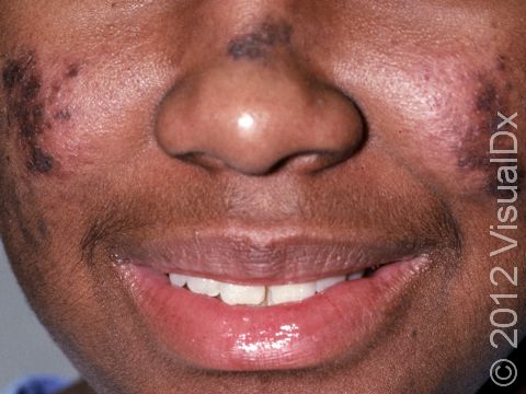 This image displays redness and deep red-purple lesions on the cheeks and nose in a 