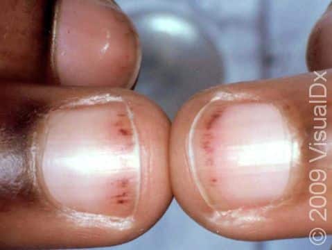 This image displays bleeding from small capillaries under the nail in a person with systemic lupus.