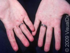 Systemic Lupus Erythematosus Condition, Treatments and Pictures for ...