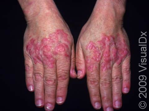 This image displays a case of lupus on the backs of the hands, worsened by sun exposure.