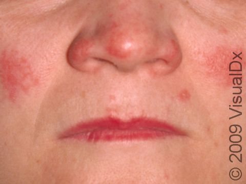 This image displays the red, slightly scaly, elevated lesions on the cheeks and nose in systemic lupus erythematosus.