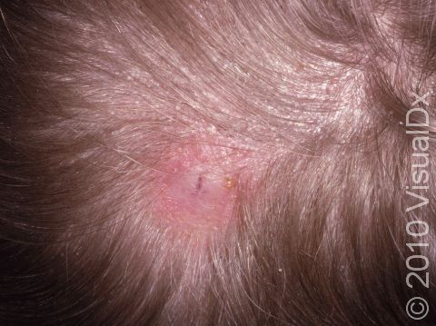 Areas of scaling, redness, and possible hair loss are typical of tinea capitis.