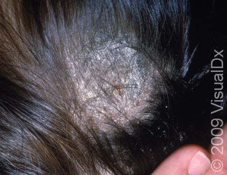 Tinea capitis (ringworm) can cause thick, white, scaly areas within the scalp.