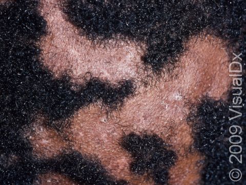 In a child with hair loss and scale on the scalp, fungal infection may be the cause.