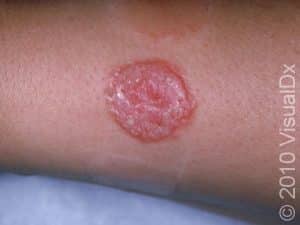 Ringworm (Tinea Corporis) Condition, Treatments and Pictures for ...