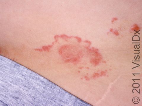 Often, tinea infections (a type of fungal infection of the skin) will have a curving edge.