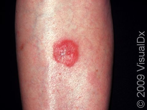 This early patch of ringworm (tinea) on the leg has the typical circular shape.