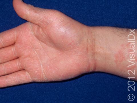 This image displays tinea manuum (hand fungus) with fine, white scaling and tinea corporis (body ringworm) with a circular lesion above the inner wrist.