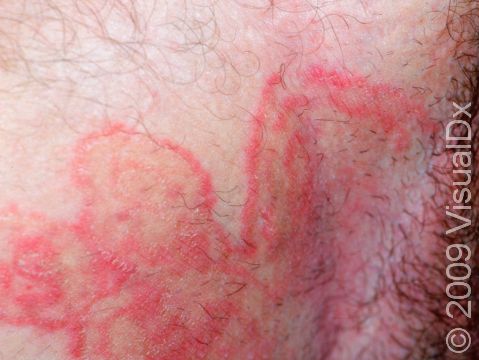 Numerous rings of tinea may intersect, causing unusual patterns as displayed in the groin of this woman.
