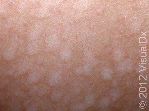 This image displays a close-up of tinea versicolor.