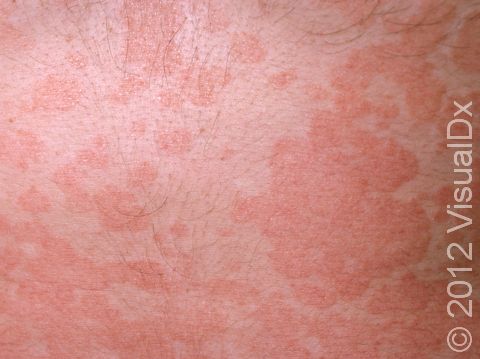 Tinea versicolor is a yeast infection, typically on the upper chest and back, which includes widespread areas of color change that are slightly scaly.