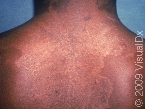 This area of tinea versicolor demonstrates why the name means 