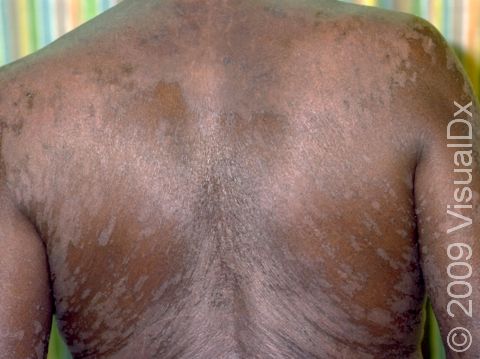 Tinea versicolor can cause widespread, lighter lesions (hypopigmented).