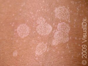 Tinea Versicolor Condition, Treatments and Pictures for Teens - Skinsight