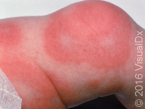 Urticaria (hives) can appear at any age, including in newborns.