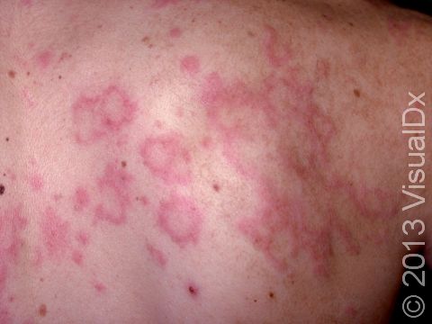 Urticaria (hives) develops quickly and has ring-like, slightly raised lesions accompanied by itch.