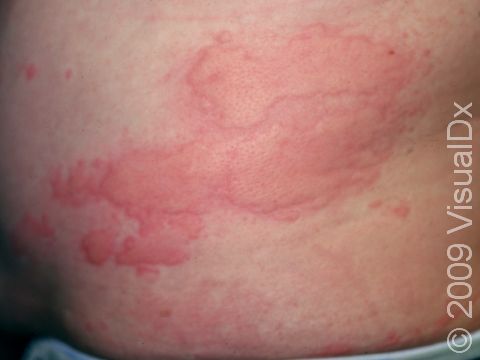 This image displays welts and large hair follicle openings caused by swelling from urticaria (hives).