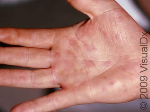 This image displays urticaria (hives) on the palms.