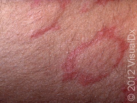 Urticaria (hives) often form rings and ring-like shapes that quickly appear and disappear.