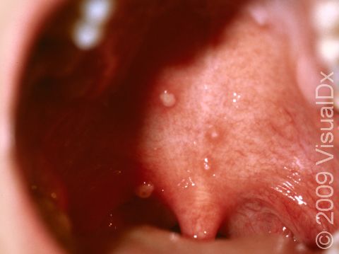This image displays chickenpox on the soft palate of the mouth.