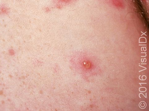 This image displays a liquid-filled chickenpox blister on a red base.