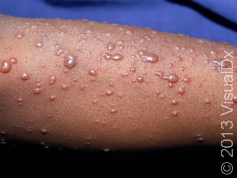 This image displays chickenpox (varicella) blisters, which are often described as 