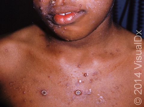 This image displays a child with chickenpox (varicella) with different stages of lesions, including intact blisters and some that have dried into scabs.