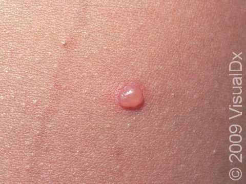 This image displays a close-up of a small varicella (chickenpox) blister.