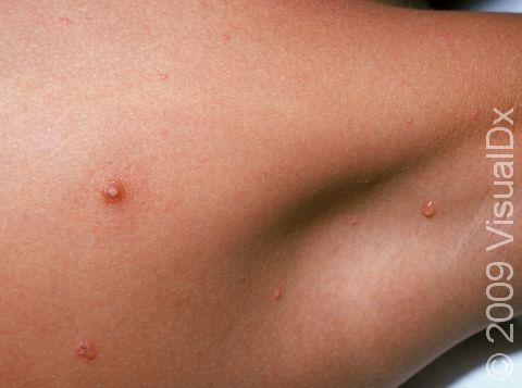 In this chickenpox (varicella) image, there are three small blisters in and around the armpit.