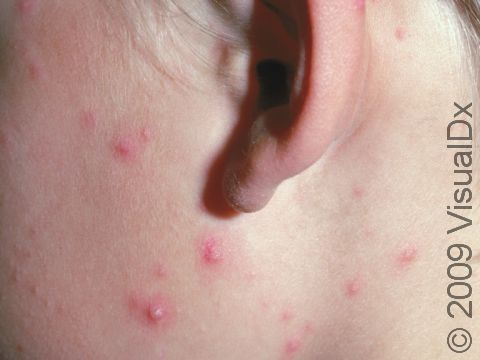 Chickenpox (varicella) typically has numerous scattered blisters (vesicles) surrounded by a pink area of skin.